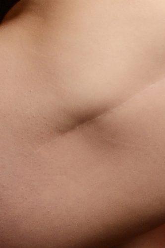 This the scar on my hip after I broke my left hip, and needed a hip replacement